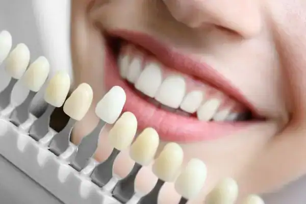 laser whitening Faqs Wellingborough